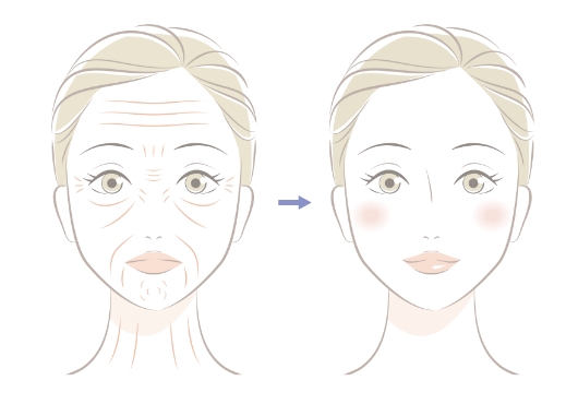 表情筋によるシワを改善
