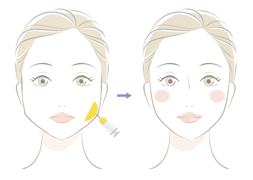 注射だけでエラの張りを解消！シャープなフェイスラインに