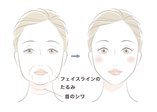 フェイスラインを引き締め、肌質の改善まで
