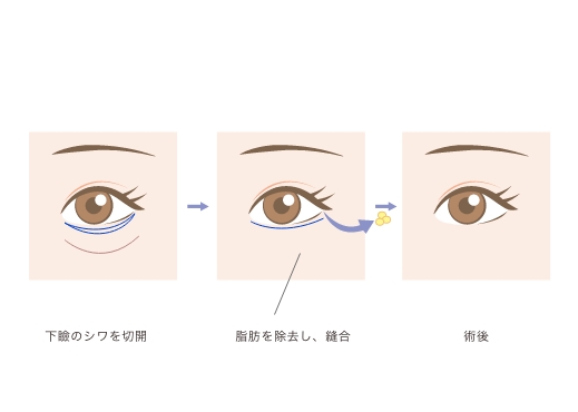 凹凸とたるみを同時に解消してハリのある目元に