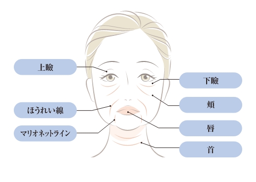 自身の脂肪を注入して、若々しい印象に