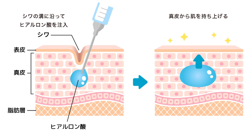 シワのある肌注入後