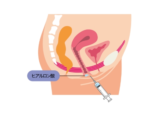 ふっくらうるおいを与えるメスを使わないお手軽治療