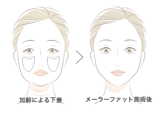 頬のもたつきとほうれい線が深くなる原因を取り除く