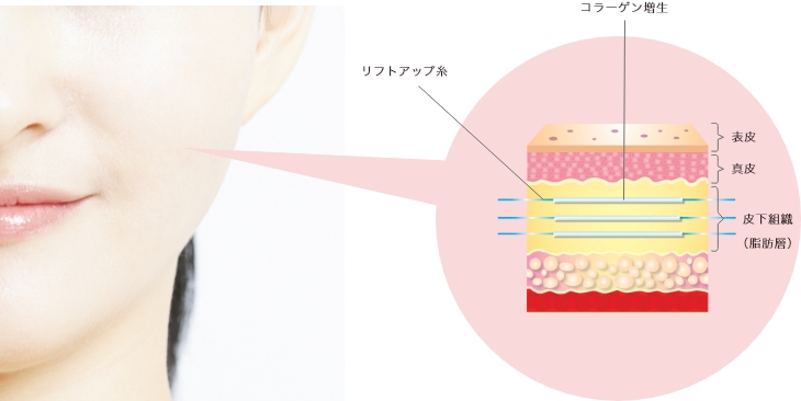 ⽷リフトとは